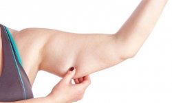 Как подтянуть обвисшую кожу рук после похудения