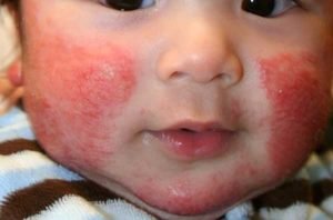 проявление у детей аллергии на холод