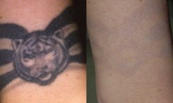 Существуют ли безопасные способы избавится от татуировки