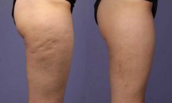 Как избавиться от жировых отложений на ногах над коленями