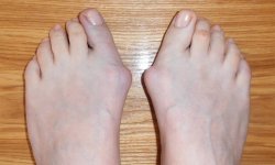 Косточки на ногах или вальгусная деформация стопы: причины появления, способы избавления