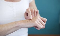 Как удалить возрастные пятна с кожи рук в домашних условиях
