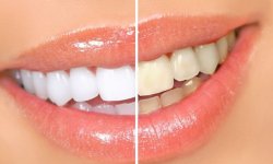 Как добиться белоснежных зубов