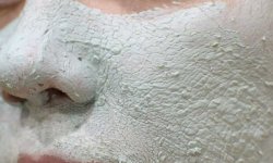 Голубая глина против угревой сыпи: самодельное средство