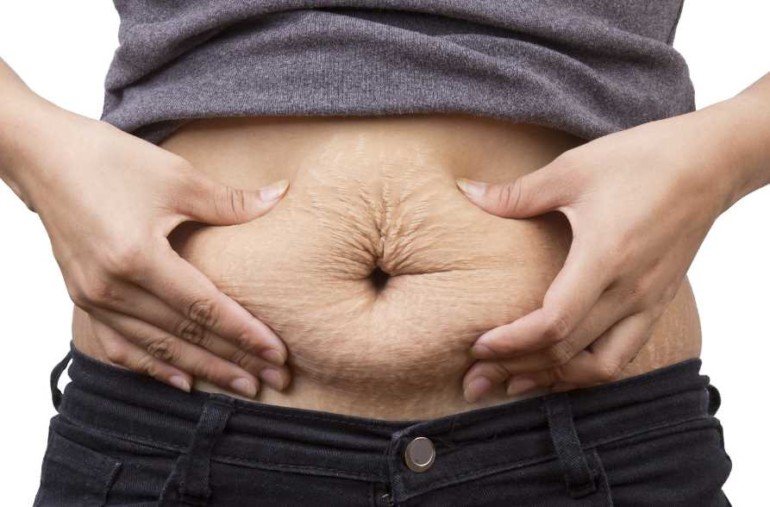 5 советов для профилактики растяжек во время похудения