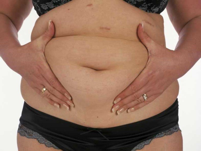 Почему у женщин с избыточным весом часто случаются проблемы с кожей