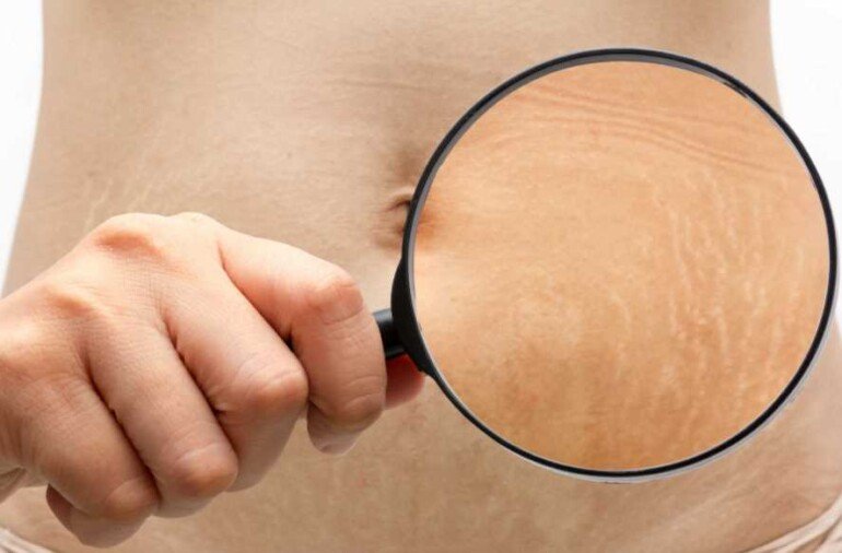 Как предотвратить растяжки на коже после похудения